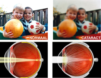 zicht met cataract
